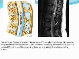 Dermal sinus. Sagittal schematic (A) and sagittal T2-weighted MR image (B) in 9-year-
old girl show intradural dermoid (stars) with tract extending from central canal to skin
surface (black arrows). Note tenting of dural sac at origin of dermal sinus (white
arrows]
 