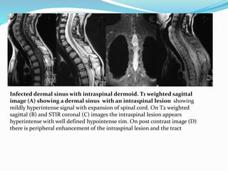 Infected dermal sinus with intraspinal dermoid. T1 weighted sagittal
image (A) showing a dermal sinus with an intraspinal lesion showing
mildly hyperintense signal with expansion of spinal cord. On T2 weighted
sagittal (B) and STIR coronal (C) images the intraspinal lesion appears
hyperintense with well defined hypointense rim. On post contrast image (D)
there is peripheral enhancement of the intraspinal lesion and the tract
 