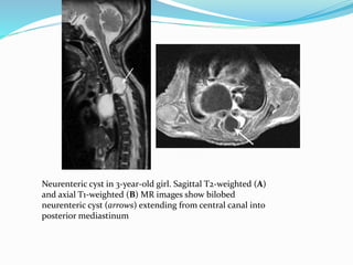 Neurenteric cyst in 3-year-old girl. Sagittal T2-weighted (A)
and axial T1-weighted (B) MR images show bilobed
neurenteric cyst (arrows) extending from central canal into
posterior mediastinum
 