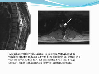 Type 1 diastematomyelia. Sagittal T2-weighted MR (A), axial T2-
weighted MR (B), and axial CT with bone algorithm (C) images in 6-
year-old boy show two dural tubes separated by osseous bridge
(arrows), which is characteristic for type 1 diastematomyelia
 