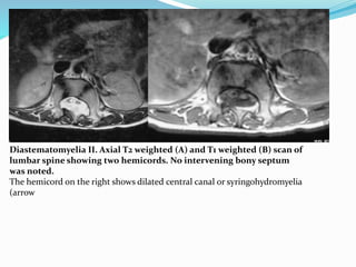 Diastematomyelia II. Axial T2 weighted (A) and T1 weighted (B) scan of
lumbar spine showing two hemicords. No intervening bony septum
was noted.
The hemicord on the right shows dilated central canal or syringohydromyelia
(arrow
 