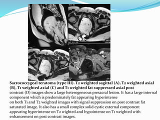 Sacrococcygeal teratoma (type III). T2 weighted sagittal (A), T2 weighted axial
(B), T1 weighted axial (C) and T1 weighted fat suppressed axial post
contrast (D) images show a large heterogeneous presacral lesion. It has a large internal
component which is predominately fat appearing hyperintense
on both T1 and T2 weighted images with signal suppression on post contrast fat
saturated image. It also has a small complex solid cystic external component
appearing hyperintense on T2 wighted and hypointense on T1 weighted with
enhancement on post contrast images.
 