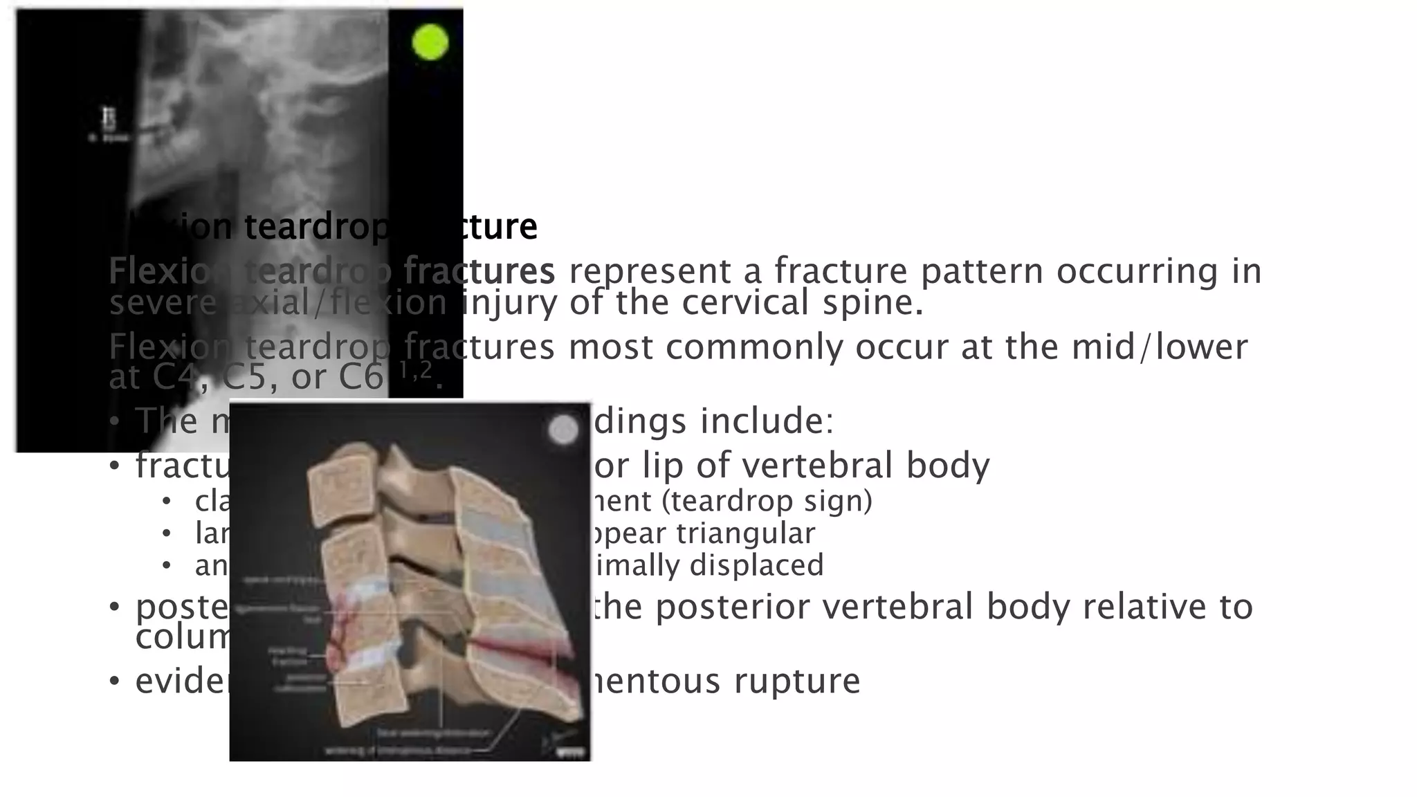 Spinal Fractures.pptx