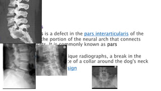 Pars Defect Types Spinal Fractures.pptx