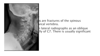 Spinal Fractures.pptx