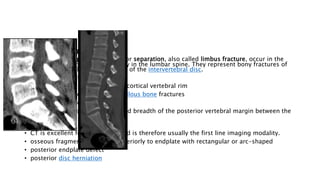 Spinal Fractures.pptx