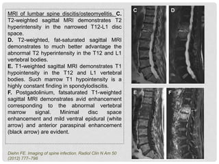 MRI of lumbar spine discitis/osteomyelitis. C.
T2-weighted sagittal MRI demonstrates T2
hyperintensity in the narrowed T12-L1 disc
space.
D. T2-weighted, fat-saturated sagittal MRI
demonstrates to much better advantage the
abnormal T2 hyperintensity in the T12 and L1
vertebral bodies.
E. T1-weighted sagittal MRI demonstrates T1
hypointensity in the T12 and L1 vertebral
bodies. Such marrow T1 hypointensity is a
highly constant finding in spondylodiscitis.
F. Postgadolinium, fatsaturated T1-weighted
sagittal MRI demonstrates avid enhancement
corresponding to the abnormal vertebral
marrow signal. Minimal disc space
enhancement and mild ventral epidural (white
arrow) and anterior paraspinal enhancement
(black arrow) are evident.
Diehn FE. Imaging of spine infection. Radiol Clin N Am 50
(2012) 777–798
 
