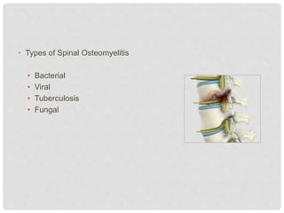 • Types of Spinal Osteomyelitis
• Bacterial
• Viral
• Tuberculosis
• Fungal
 