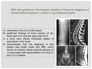 • MRI with gadolinium: the imaging modality of choice for diagnosis of
spinal epidural abscess. it shows a ring enhancing lesion
A. narrowing of the L3–L4 disk space
B. additional findings of bone erosion of the
lower part of L3 and the upper part of L4
C. a bone scan shows increased uptake of
technetium in the lower
D. demonstrates how the diagnosis in this
patient was finally made with MRI, which
shows an anterior spinal epidural abscess at
L4 associated with osteomyelitis of L3 and L4
and L3–L4 diskitis.
 