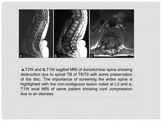 a.T2W and b.T1W sagittal MRI of dorsolumbar spine showing
destruction due to spinal TB of T8/T9 with some preservation
of the disc. The importance of screening the entire spine is
highlighted with the non-contiguous lesion noted at L3 and c.
T1W axial MRI of same patient showing cord compression
due to an abscess
 
