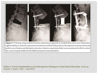 Dhillon A. Positive Sagittal Balance and Management Strategies in Adult Spinal Deformities. Int jor sp.
Volume 1 | Issue 1 | Apr – June 2016
 