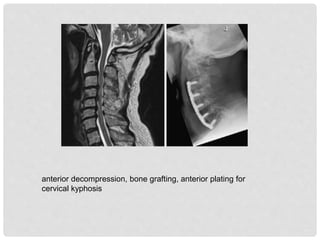 anterior decompression, bone grafting, anterior plating for
cervical kyphosis
 
