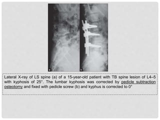 Lateral X-ray of LS spine (a) of a 15-year-old patient with TB spine lesion of L4–5
with kyphosis of 25°. The lumbar kyphosis was corrected by pedicle subtraction
osteotomy and fixed with pedicle screw (b) and kyphus is corrected to 0°
 