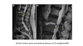 Discitis Back Spinal infections | PPTX