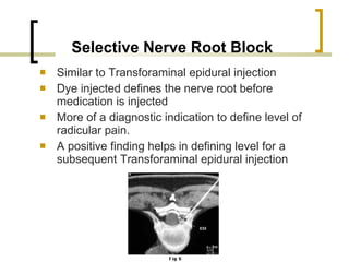 Root Block Inj Spinal Injections | PPT