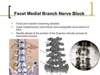 Spinal Injections | PPT