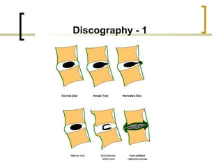 Discography Injection Spinal Injections | PPT
