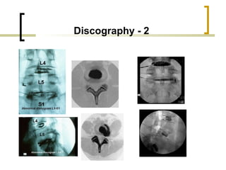 Discography Injection Spinal Injections | PPT
