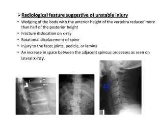 Radiological feature suggestive of unstable injury
• Wedging of the body with the anterior height of the vertebra reduced more
than half of the posterior height
• Fracture dislocation on x-ray
• Rotational displacement of spine
• Injury to the facet joints, pedicle, or lamina
• An increase in space between the adjacent spinous processes as seen on
lateral x-ray.
 