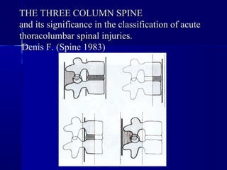 TTHHEE TTHHRREEEE CCOOLLUUMMNN SSPPIINNEE 
aanndd iittss ssiiggnniiffiiccaannccee iinn tthhee ccllaassssiiffiiccaattiioonn ooff aaccuuttee 
tthhoorraaccoolluummbbaarr ssppiinnaall iinnjjuurriieess.. 
DDeenniiss FF.. ((SSppiinnee 1199833)) 
 