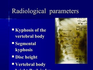 RRaaddiioollooggiiccaall ppaarraammeetteerrss 
 KKyypphhoossiiss ooff tthhee 
vveerrtteebbrraall bbooddyy 
 SSeeggmmeennttaall 
kkyypphhoossiiss 
 DDiisscc hheeiigghhtt 
 VVeerrtteebbrraall bbooddyy 
hheeiigghhtt::BBeecckk iinnddeexx 
 