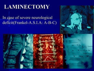 LLAAMMIINNEECCTTOOMMYY 
IInn ccaassee ooff sseevveerree nneeuurroollooggiiccaall 
ddeeffiicciitt((FFrraannkkeell--AA..SS..II..AA:: AA--BB--CC)) 
 