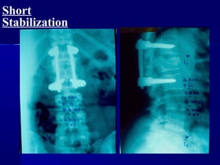 Short 
Stabilization 
 