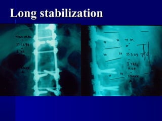 LLoonngg ssttaabbiilliizzaattiioonn 
 