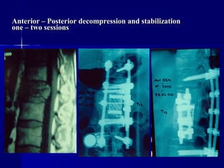 Anterior – Posterior decompression aanndd ssttaabbiilliizzaattiioonn 
oonnee –– ttwwoo sseessssiioonnss 
 