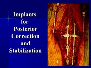 IImmppllaannttss 
ffoorr 
PPoosstteerriioorr 
CCoorrrreeccttiioonn 
aanndd 
SSttaabbiilliizzaattiioonn 
 