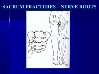 SACRUM FRACTURES – NERVE ROOTS 
 