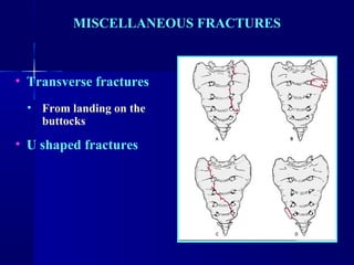 MISCELLANEOUS FRACTURES 
• Transverse fractures 
• From landing on the 
buttocks 
• U shaped fractures 
 
