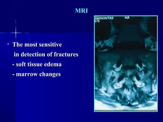 MRI 
• The most sensitive 
in detection of fractures 
- soft tissue edema 
- marrow changes 
 