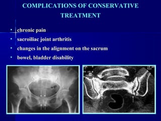 COMPLICATIONS OF CONSERVATIVE 
TREATMENT 
• chronic pain 
• sacroiliac joint arthritis 
• changes in the alignment on the sacrum 
• bowel, bladder disability 
 