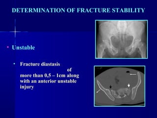 DETERMINATION OF FRACTURE STABILITY 
• Unstable 
• Fracture diastasis 
of 
more than 0,5 – 1cm along 
with an anterior unstable 
injury 
 
