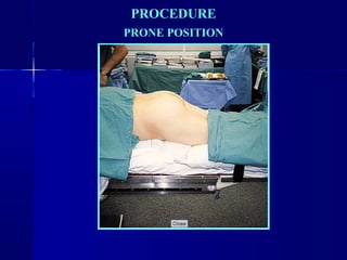 PROCEDURE 
PRONE POSITION 
 