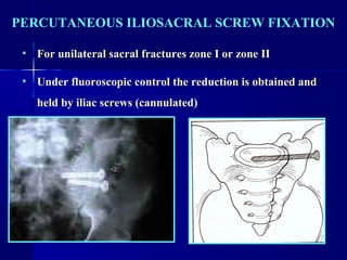 PERCUTANEOUS ILIOSACRAL SCREW FIXATION 
• For unilateral sacral fractures zone I or zone II 
• Under fluoroscopic control the reduction is obtained and 
held by iliac screws (cannulated) 
 