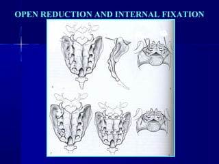 OPEN REDUCTION AND INTERNAL FIXATION 
 