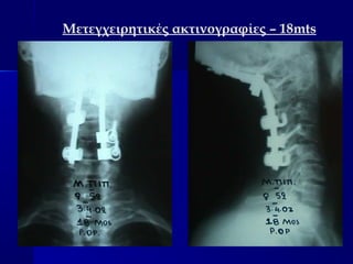 Μετεγχειρητικές ακτινογραφίες – 18mts 
 