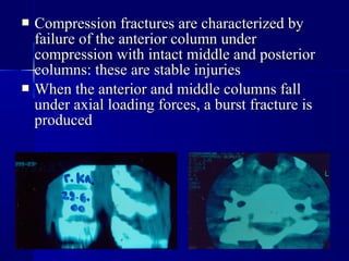  Compression fractures aarree cchhaarraacctteerriizzeedd bbyy 
ffaaiilluurree ooff tthhee aanntteerriioorr ccoolluummnn uunnddeerr 
ccoommpprreessssiioonn wwiitthh iinnttaacctt mmiiddddllee aanndd ppoosstteerriioorr 
ccoolluummnnss:: tthheessee aarree ssttaabbllee iinnjjuurriieess 
 WWhheenn tthhee aanntteerriioorr aanndd mmiiddddllee ccoolluummnnss ffaallll 
uunnddeerr aaxxiiaall llooaaddiinngg ffoorrcceess,, aa bbuurrsstt ffrraaccttuurree iiss 
pprroodduucceedd 
 