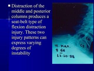  DDiissttrraaccttiioonn ooff tthhee 
mmiiddddllee aanndd ppoosstteerriioorr 
ccoolluummnnss pprroodduucceess aa 
sseeaatt--bbeelltt ttyyppee ooff 
fflleexxiioonn ddiissttrraaccttiioonn 
iinnjjuurryy.. TThheessee ttwwoo 
iinnjjuurryy ppaatttteerrnnss ccaann 
eexxpprreessss vvaarryyiinngg 
ddeeggrreeeess ooff 
iinnssttaabbiilliittyy 
 