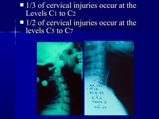  11//33 ooff cceerrvviiccaall iinnjjuurriieess ooccccuurr aatt tthhee 
LLeevveellss CC11 ttoo CC22 
 11//22 ooff cceerrvviiccaall iinnjjuurriieess ooccccuurr aatt tthhee 
lleevveellss CC55 ttoo CC77 
 