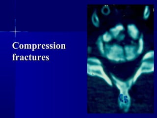 CCoommpprreessssiioonn 
ffrraaccttuurreess 
 