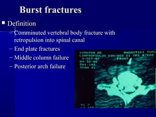 BBuurrsstt ffrraaccttuurreess 
 DDeeffiinniittiioonn 
– CCoommmmiinnuutteedd vveerrtteebbrraall bbooddyy ffrraaccttuurree wwiitthh 
rreettrrooppuullssiioonn iinnttoo ssppiinnaall ccaannaall 
– EEnndd ppllaattee ffrraaccttuurreess 
– MMiiddddllee ccoolluummnn ffaaiilluurree 
– PPoosstteerriioorr aarrcchh ffaaiilluurree 
 