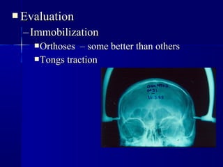 EEvvaalluuaattiioonn 
– IImmmmoobbiilliizzaattiioonn 
OOrrtthhoosseess –– ssoommee bbeetttteerr tthhaann ootthheerrss 
TToonnggss ttrraaccttiioonn 
 