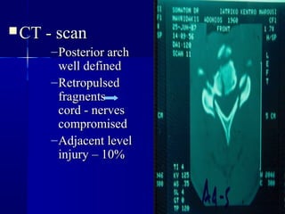 CCTT -- ssccaann 
–PPoosstteerriioorr aarrcchh 
wweellll ddeeffiinneedd 
–RReettrrooppuullsseedd 
ffrraaggnneennttss 
ccoorrdd -- nneerrvveess 
ccoommpprroommiisseedd 
–AAddjjaacceenntt lleevveell 
iinnjjuurryy –– 1100%% 
 