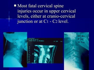 MMoosstt ffaattaall cceerrvviiccaall ssppiinnee 
iinnjjuurriieess ooccccuurr iinn uuppppeerr cceerrvviiccaall 
lleevveellss,, eeiitthheerr aatt ccrraanniioo--cceerrvviiccaall 
jjuunnccttiioonn oorr aatt CC11 -- CC22 lleevveell.. 
 
