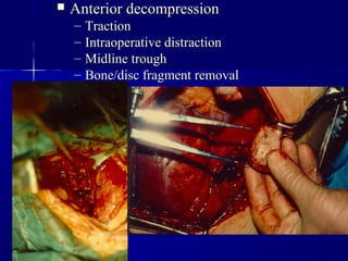  AAnntteerriioorr ddeeccoommpprreessssiioonn 
– TTrraaccttiioonn 
– IInnttrraaooppeerraattiivvee ddiissttrraaccttiioonn 
– MMiiddlliinnee ttrroouugghh 
– BBoonnee//ddiisscc ffrraaggmmeenntt rreemmoovvaall 
 