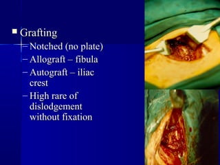  GGrraaffttiinngg 
– NNoottcchheedd ((nnoo ppllaattee)) 
– AAllllooggrraafftt –– ffiibbuullaa 
– AAuuttooggrraafftt –– iilliiaacc 
ccrreesstt 
– HHiigghh rraarree ooff 
ddiissllooddggeemmeenntt 
wwiitthhoouutt ffiixxaattiioonn 
 