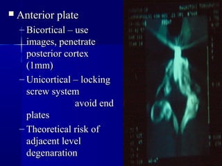 AAnntteerriioorr ppllaattee 
– BBiiccoorrttiiccaall –– uussee 
iimmaaggeess,, ppeenneettrraattee 
ppoosstteerriioorr ccoorrtteexx 
((1mmmm)) 
– UUnniiccoorrttiiccaall –– lloocckkiinngg 
ssccrreeww ssyysstteemm 
aavvooiidd eenndd 
ppllaatteess 
– TThheeoorreettiiccaall rriisskk ooff 
aaddjjaacceenntt lleevveell 
ddeeggeennaarraattiioonn 
 